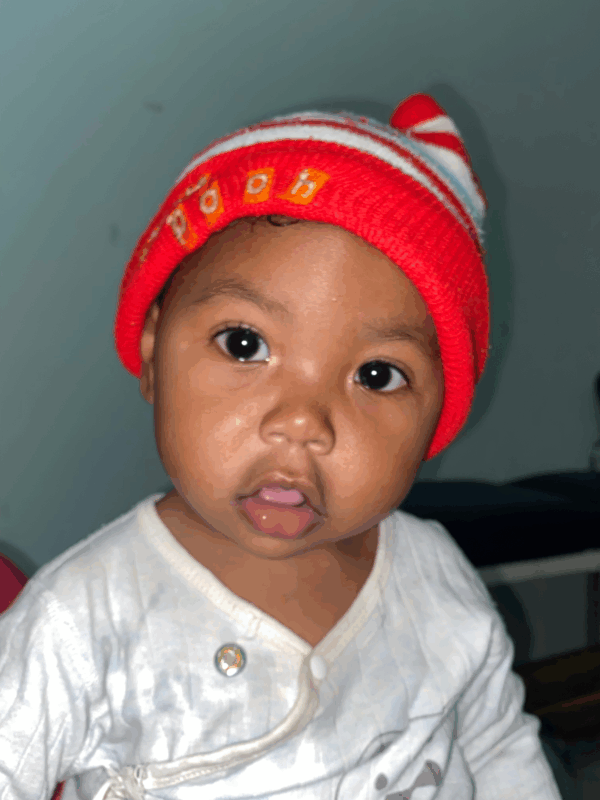 Marcella in Madagascar born with cleft