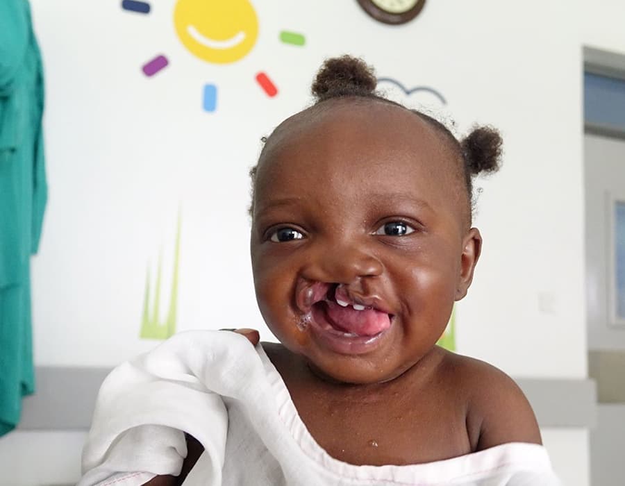 Uganda-Blessing-Cleft-CoRSU Uganda-Blessing-Cleft-CoRSU