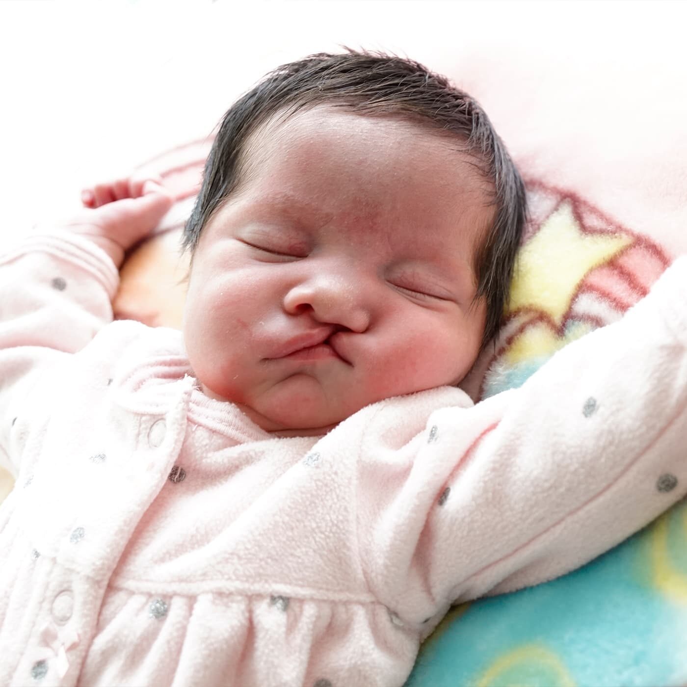 cc-what-is-cleft-care Sleeping baby with a cleft lip